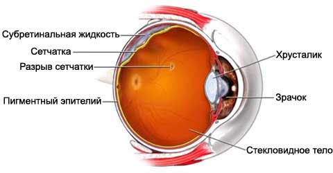 Лечение отслоения сетчатки глаза