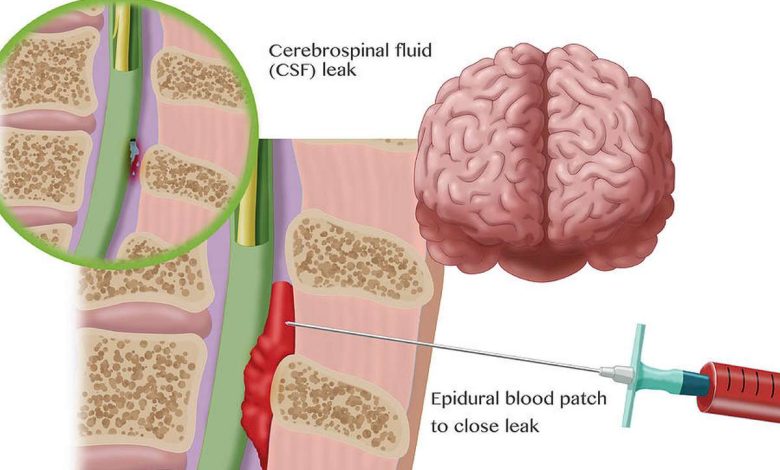 Epidural blood patch, EPA: what is the procedure, causes, Contraindications, how they do it, what after