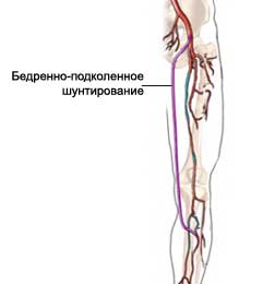 Бедренно-подколенное шунтирование - Шунтирование артерии ноги