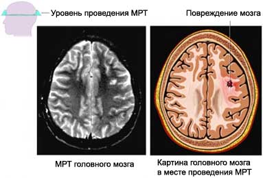 МРТ головного мозга после травмы