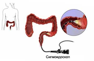Гибкая ректороманоскопия - Сигмоидоскопия гибкая