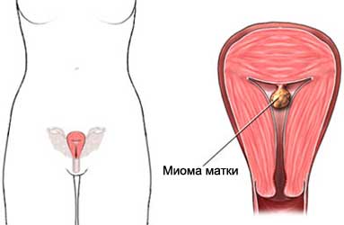 Миомэктомия - открытая операция - Удаление миомы матки