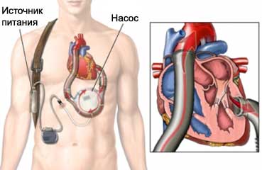 Искусственный желудочек сердца - Желудочковое вспомогательное устройство