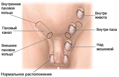 Орхопексия - Орхидопексия - лапароскопическая операция