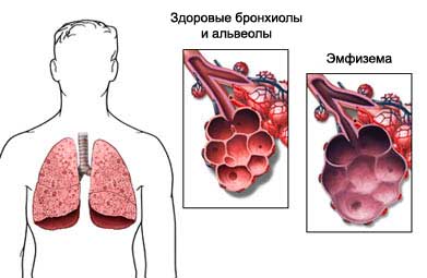 Пересадка легких - Трансплантация легких