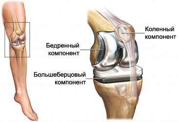 Замена коленного сустава - Эндопротезирование коленного сустава