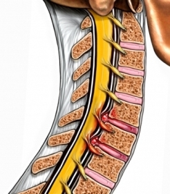 Разрыв позвоночного диска и зажатые нервы в шее