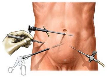 Лапароскопия - Операция через «замочную скважину»