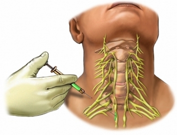 Укол анестезии в периферические нервы