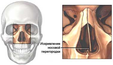 Ринопластика - Пластическая хирургия носа