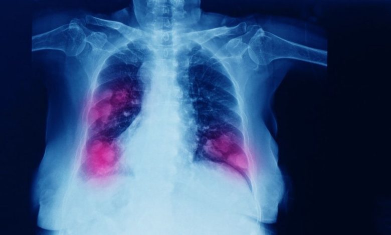 Pulmonell lobektomi, avlägsnande av en lunglob: vad är denna operation, orsaker, Kontra, hur de gör, vad efter - Andningssystem - Lungor