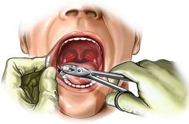 Хирургическое удаление зуба