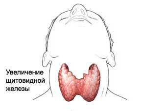 Увеличение щитовидной железы
