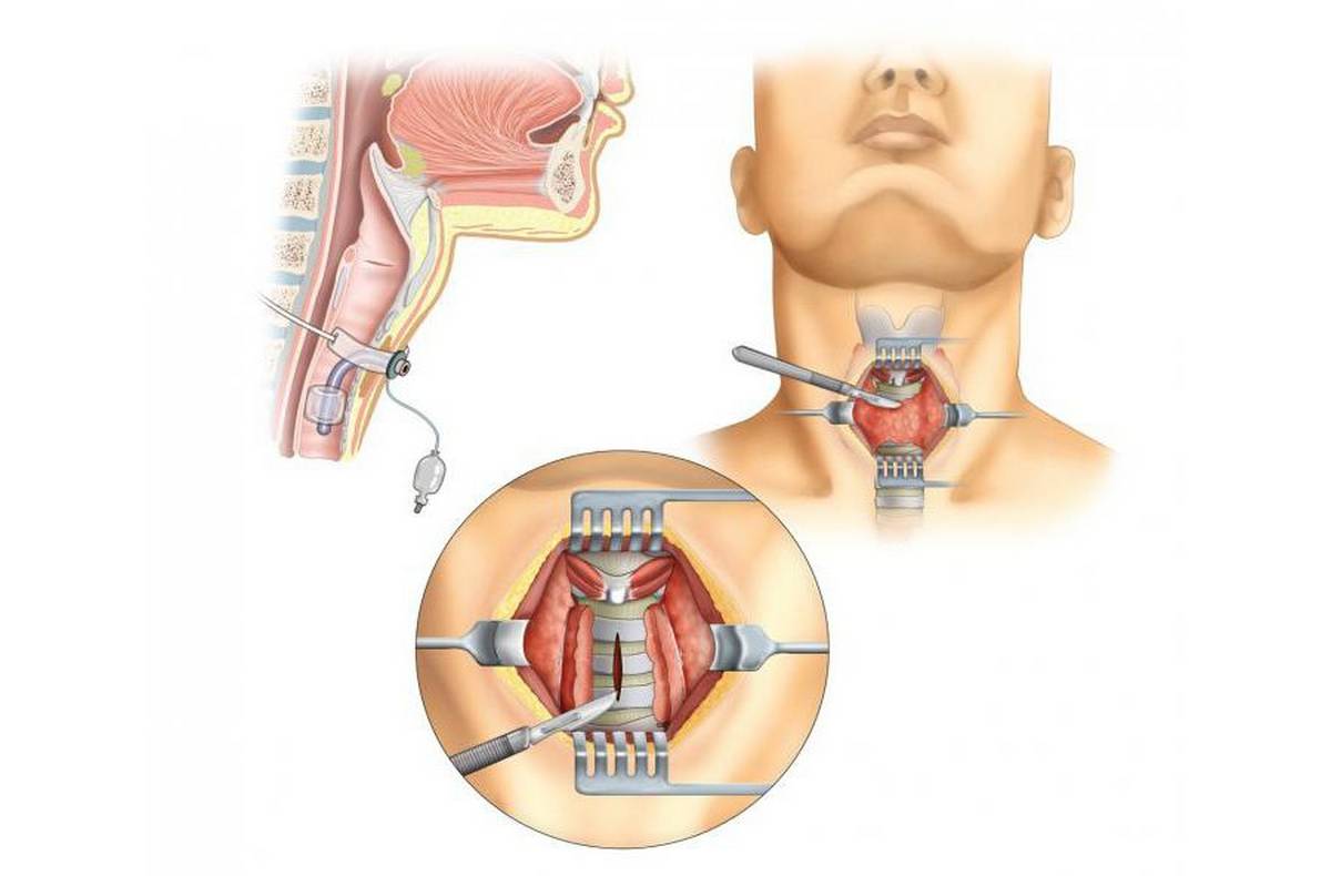 Почему душит горло. Трахеостомия трубка дыхательная. Трахеостома - Стома трахеи.. Трахеостомическая трубка в горле.