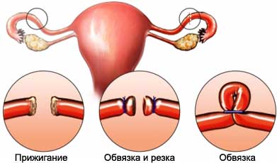 Перевязка маточных труб - лапароскопическая операция - Трубная стерилизация