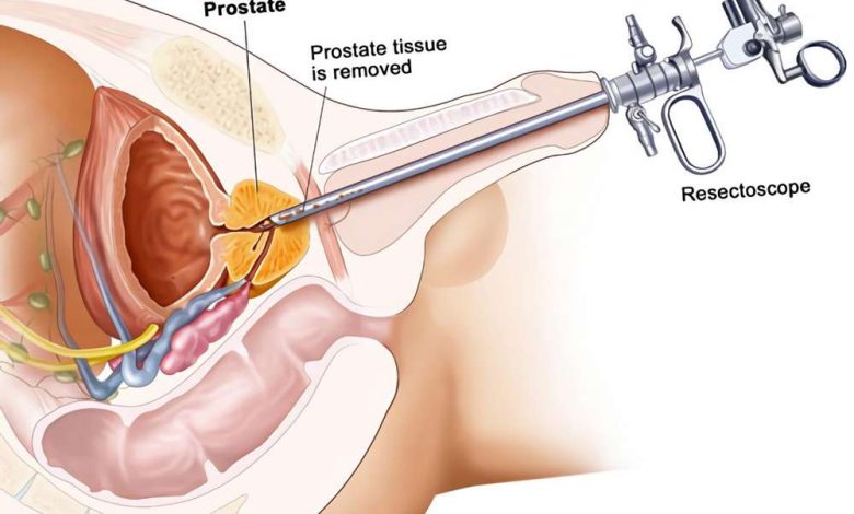 Resection melalui saluran kencing prostat, TURP: apakah operasi ini, bagaimana mereka lakukan, kontraindikasi, selepas apa