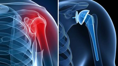 Shoulder Penggantian Bersama, artroplasti bahu: operasi apa ini?, Penyebab, Kontraindikasi, bagaimana mereka melakukannya?, setelah apa