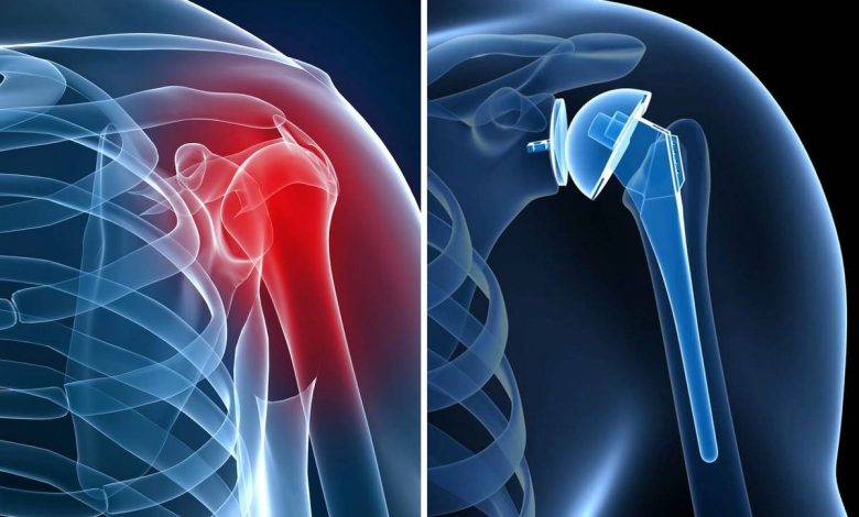Shoulder Joint Replacement, shoulder arthroplasty: what is this operation, causes, Contraindications, how they do it, what after