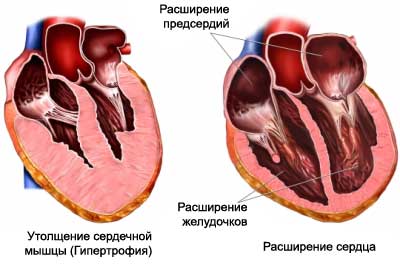 Патологии сердечной стенки