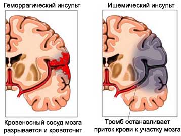 Инсульт - Нарушение мозгового кровообращения