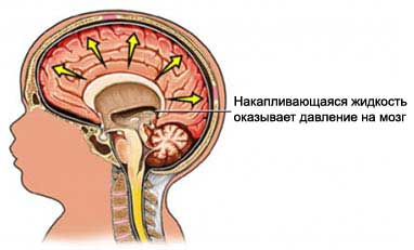 Гидроцефалия - Водянка головного мозга