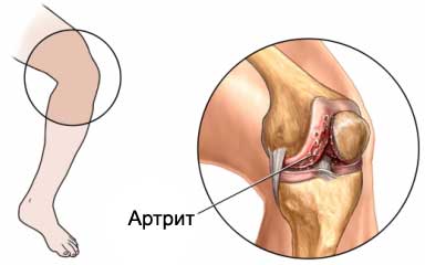 Повреждение сустава в колене