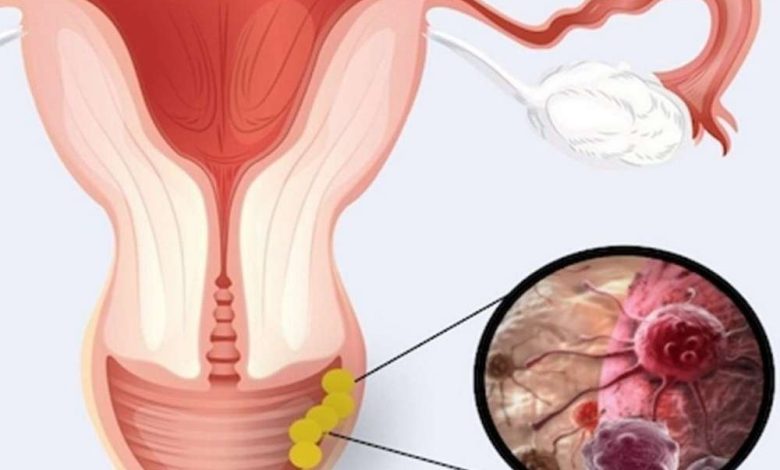 Vulvectomy: c'est quoi cette opération, les causes, Contre-, comment ils font, et après - Cancer de la vulve - Organes génitaux féminins