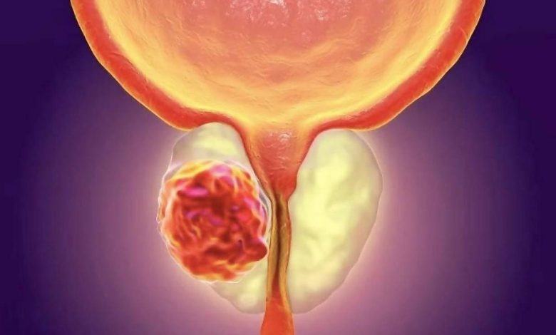 GPH, gerybinė prostatos hiperplazija: kas tai, simptomai, diagnozės gydymas, prevencija