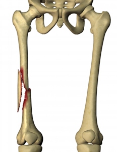 Перелом бедренной кости - Перелом ноги