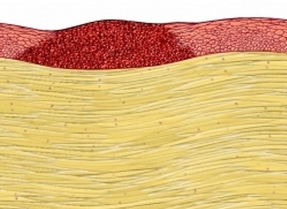 Себорейный кератоз на поверхности кожи