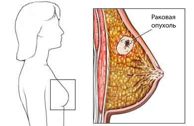 Рак молочной железы - Рак груди