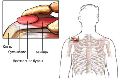 Бурсит в плече