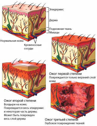 Классификация ожогов кожи