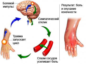 Комплексный региональный болевой синдром