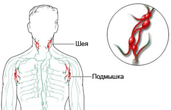 Увеличение лимфатических узлов