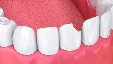 Patah gigi (gigi patah), gigi retak: Apakah ini, gejala, rawatan diagnosis, pencegahan