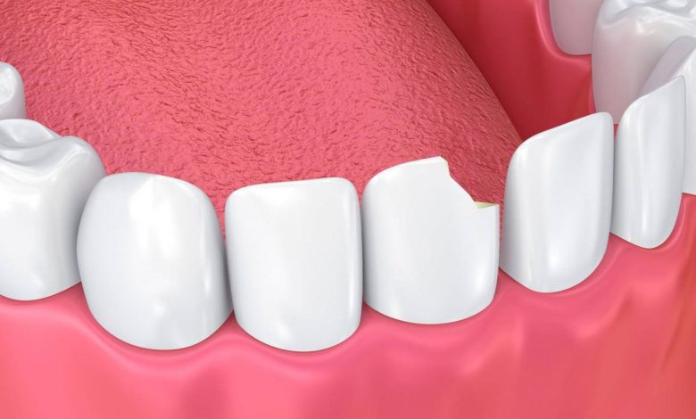 Fratura de dente (dente quebrado), rachadura de dente: O que é isto, sintomas, diagnóstico tratamento, prevenção