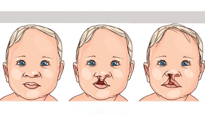 Орально-лицевые расщелины - заячья губа, волчья пасть: что это такое, симптомы, диагностика лечение, профилактика