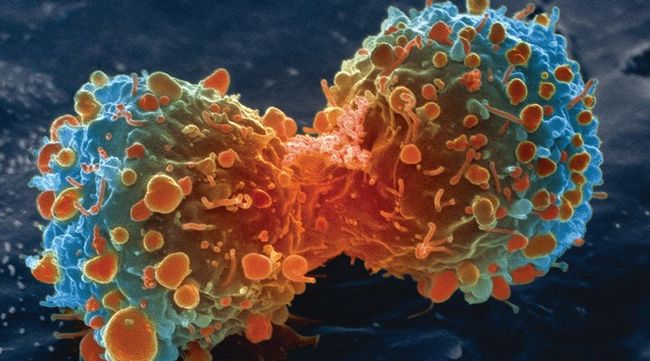 Vēža šūnas
