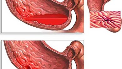 Gastrointestinalnog krvarenja: što je to, uzrok, simptomi, dijagnostika, liječenje, prevencija