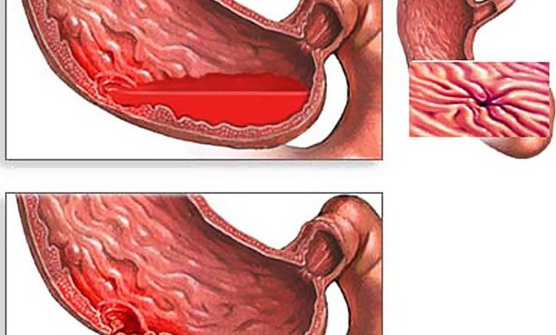 Chảy máu dạ dày: Cái này là cái gì, nguyên nhân của, triệu chứng, chẩn đoán, điều trị, phòng