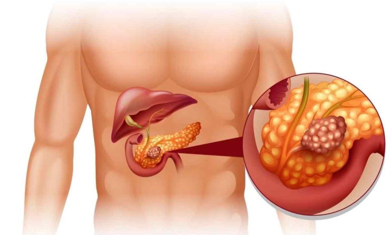 Cisti del pancreas: cos'è questo, la causa della, sintomi, diagnostica, trattamento, prevenzione