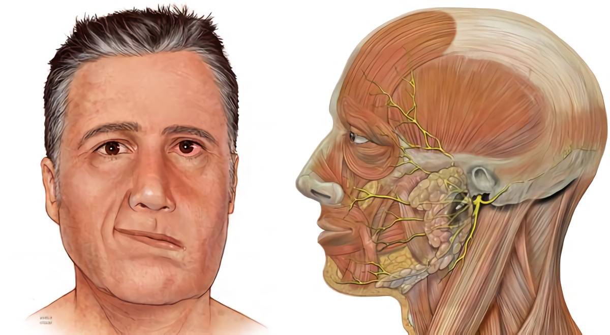 Лицевой нерв после операции. Парез лицевого нерва и тройничного. Неврит лицевого нерва. Отогенный неврит лицевого нерва. Периферический неврит лицевого нерва.