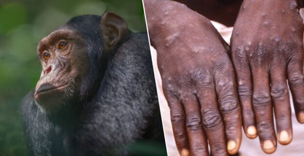 Первый случай заражения человека оспой обезьян выявлен в Австралии - Оспа обезьян