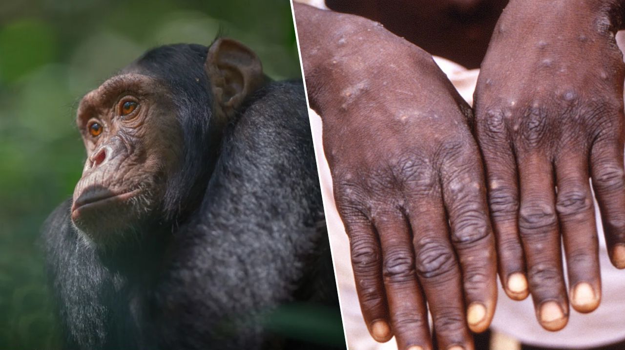 Первый случай заражения человека оспой обезьян выявлен в Австралии - Оспа обезьян