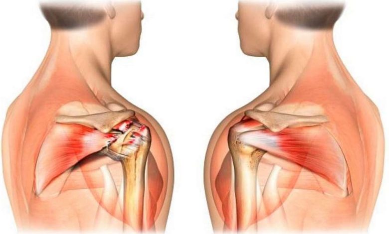 Ombro tendinopatia, lesão do tendão do bíceps: O que é, tratamento, sintomas, diagnóstico, prevenção