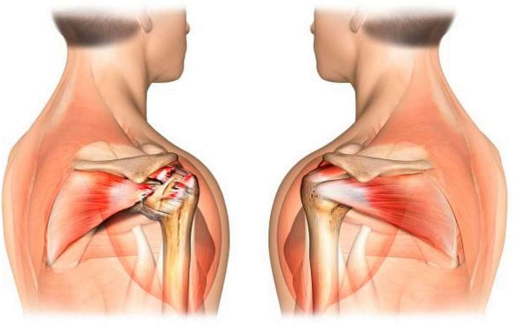 Травмы мышц и сухожилий