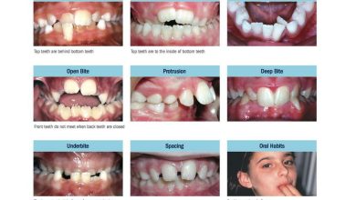 Forme irrégulière des dents: qu'est-ce que c'est, les causes, symptômes, diagnostic, traitement, prévention