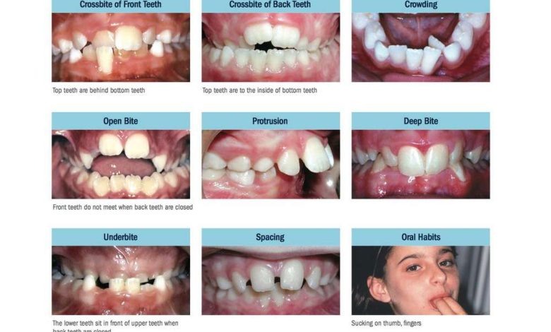 दांतों का अनियमित आकार: यह क्या है, का कारण बनता है, लक्षण, निदान, इलाज, निवारण