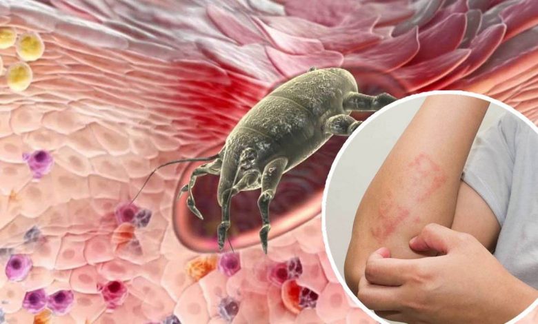 Fast treatment of scabies at home with folk remedies and drugs